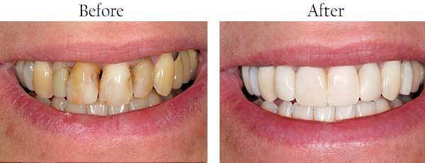 Before and After Teeth Whitening