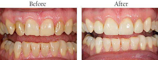 Before and After Invisalign