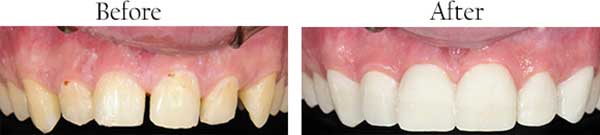 Before and After Invisalign