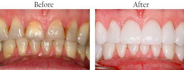 Before and After Dental Implants