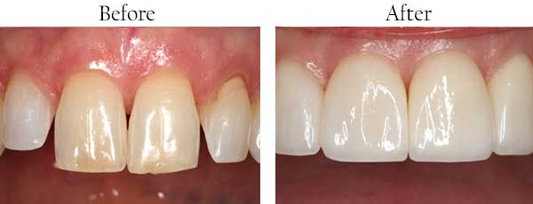 Before and After Teeth Whitening