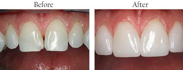 Before and After Dental Implants